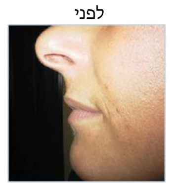 lips-b4